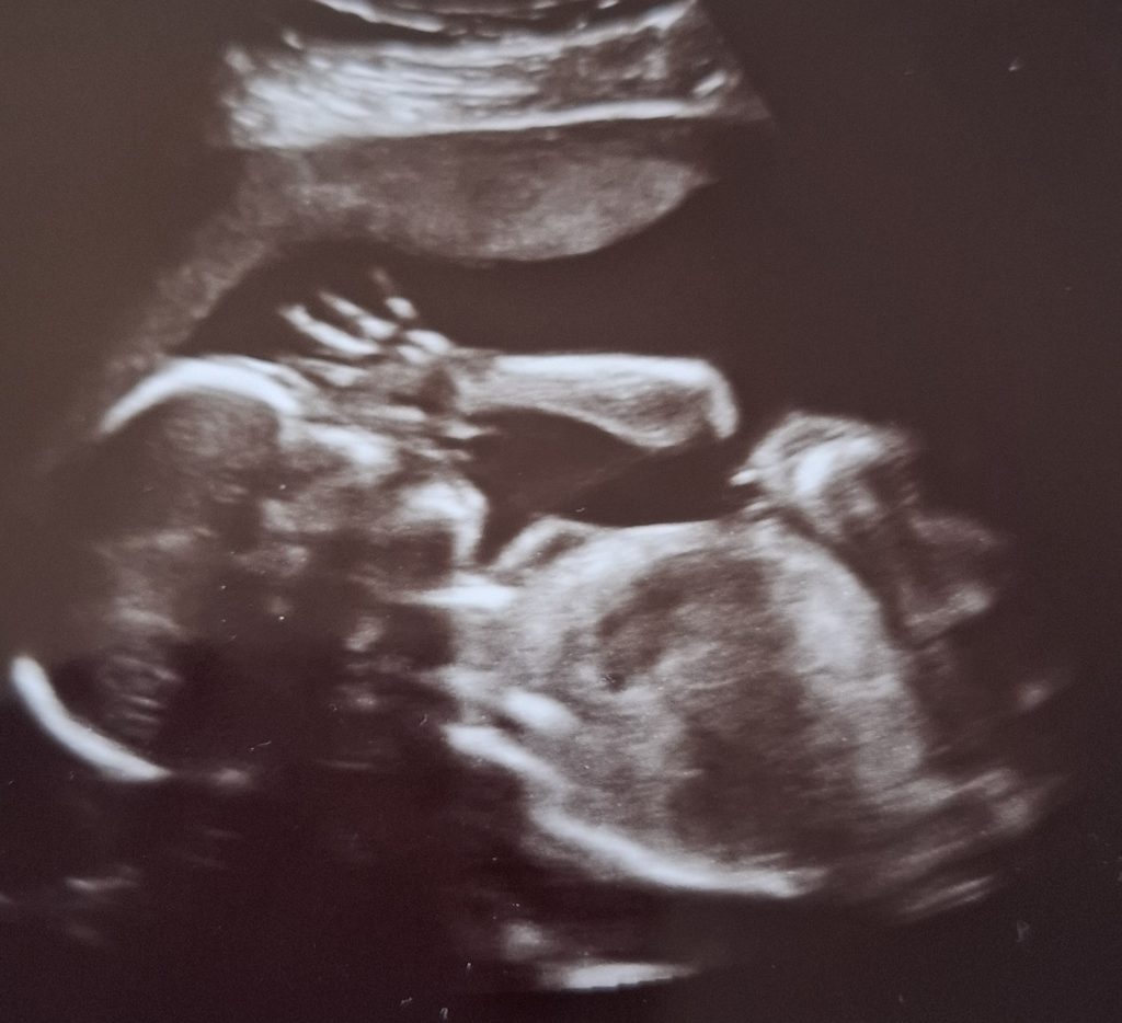 ultraschall_baby